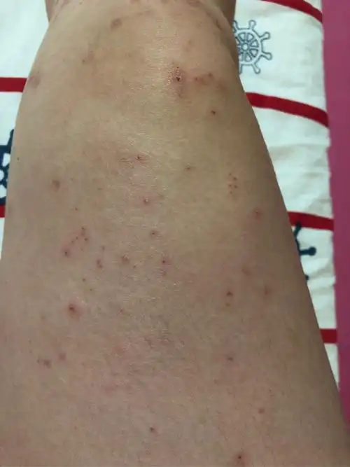 孕晚期 全身湿疹 不想活了 太丑了