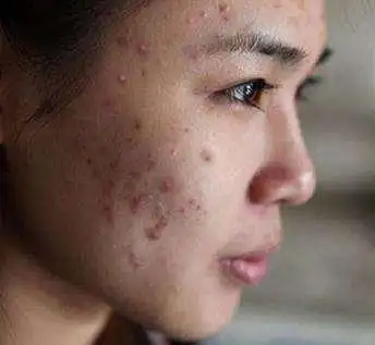 油性皮肤怎么祛痘?不花钱也能有效对抗油性痘痘肌