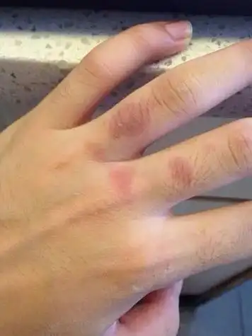 一度烫伤疤痕图片