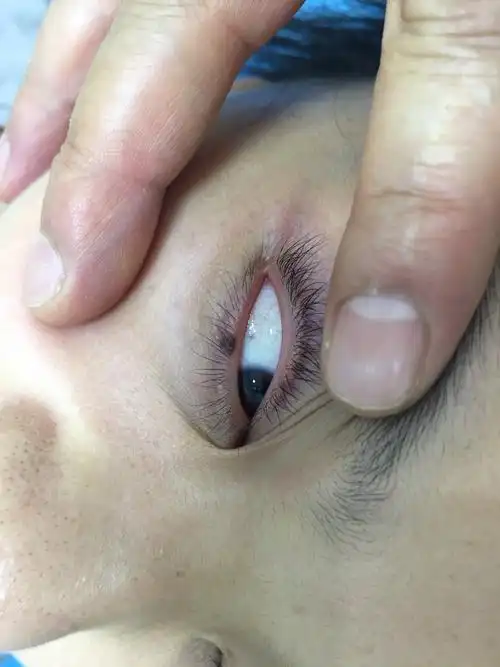 睑缘痣激光治疗前后图片 - 好大夫在线