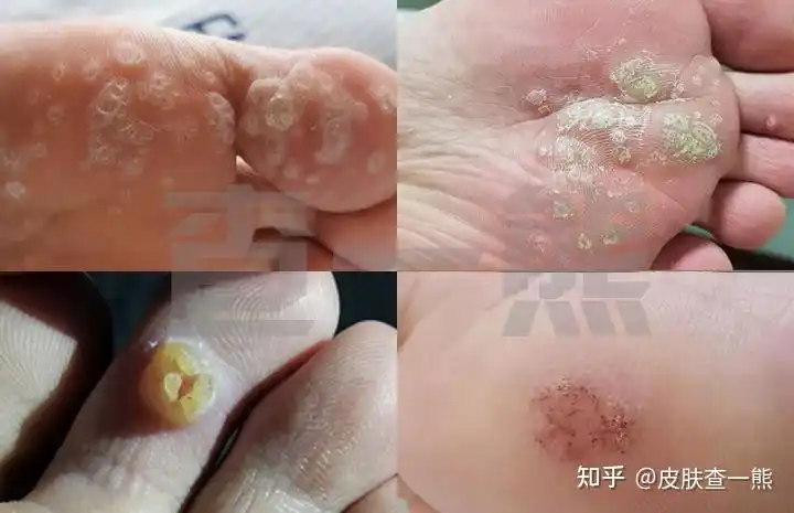 1,简说鸡眼鸡眼,又叫肉刺.多指足部鸡眼.