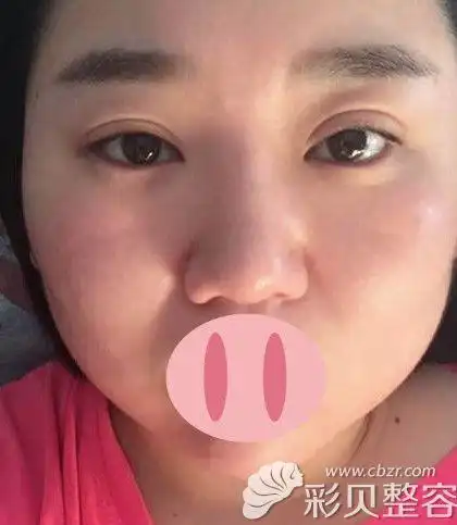 埋线双眼皮失败