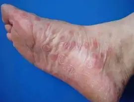 男性刚得了梅毒的照片