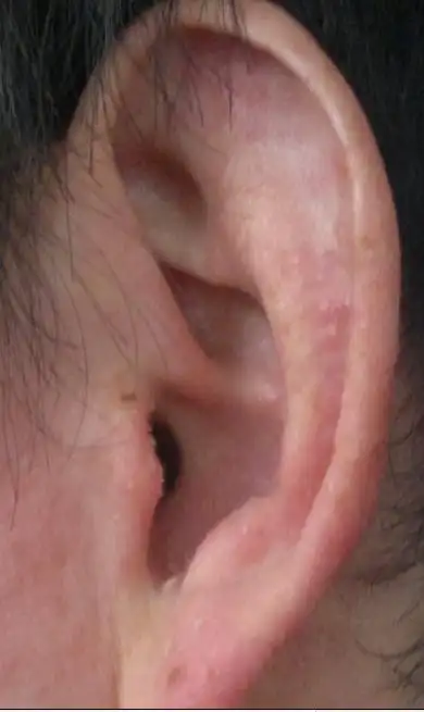 耳朵痒了红了这是什么病?如图