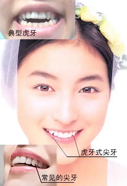 补充一下:所指的"虎牙"学名为尖牙,通常为圆钝型状,当为锐角型时