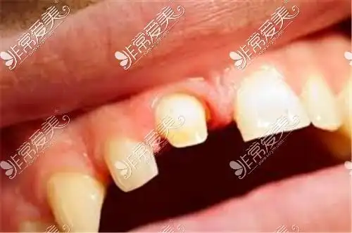 臭美把牙齿磨小了不想戴牙冠怎么办作精爱美的下场太惨