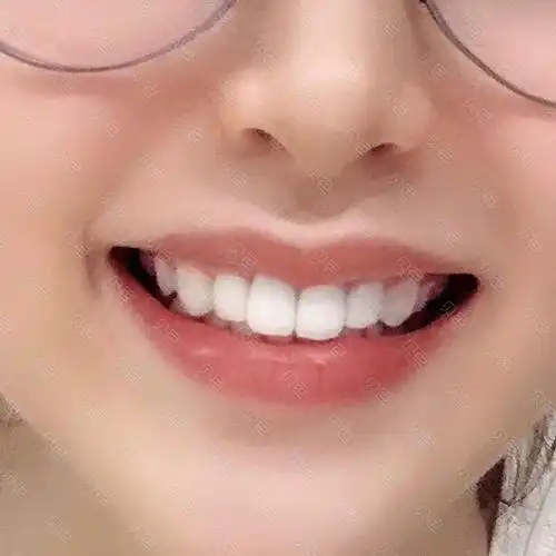 原本健康的牙齿做了全瓷牙,人生后悔事之一