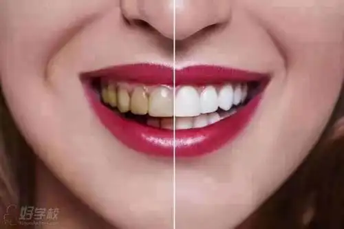 深圳纳米树脂全瓷贴面美牙培训班