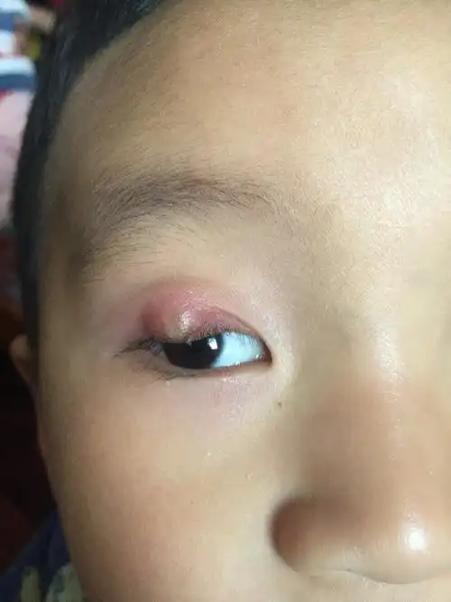 四岁宝宝眼睛又成这样了去年也搞了一次 把里面的脓了好了 的没想到今