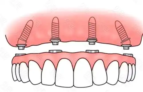 半口种植牙示意图