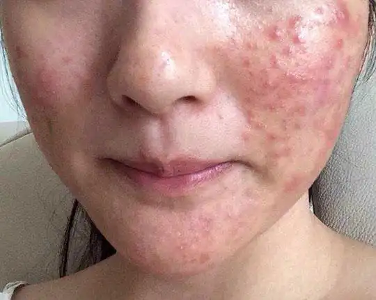 去除痘痘肌肤,丑小鸭也可以变天鹅