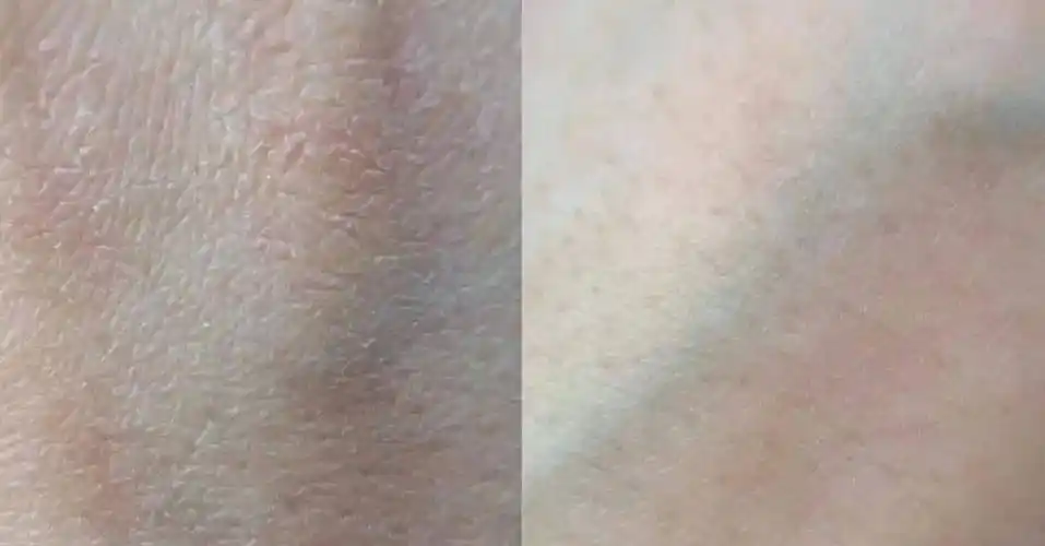 放大对比仔细看,细小的纹路,皮褶都 被撑了起来!