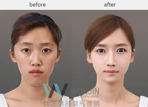 "美白针"效果对比图