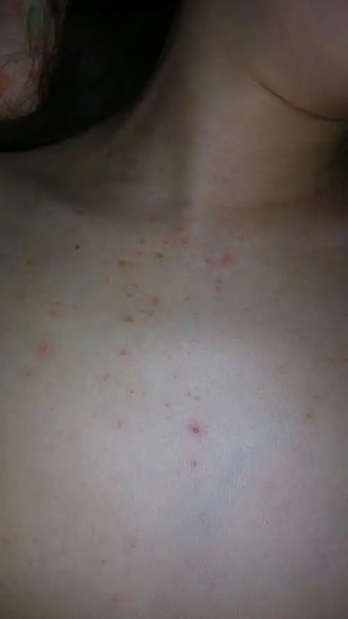 问:您好,我胸口长了好多红疙瘩,半年了不见好,请问一下您能告诉我这是