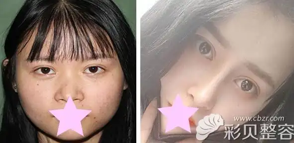 线雕隆鼻前后效果案例对比图