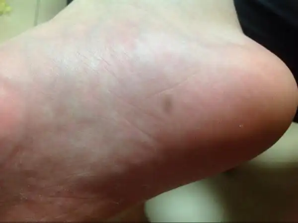 请看图:脚底出现类圆形深褐色"痣"