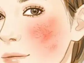 问题肌肤修复!——红血丝