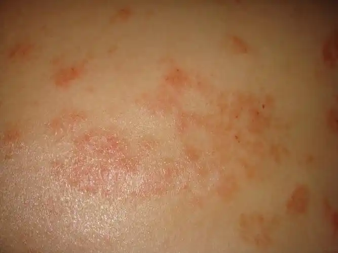 过敏性皮炎1例 - 皮肤及性传播疾病讨论版 - 爱爱医医学论坛