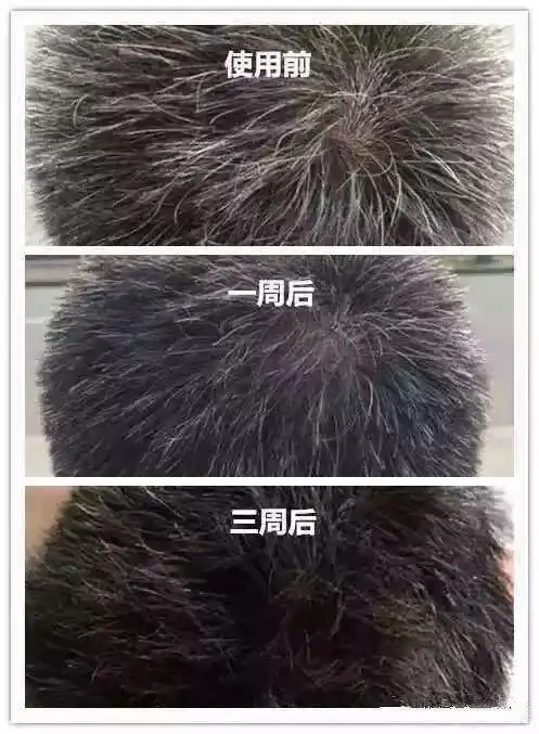 无需水洗,不伤头皮,3 周白发变黑发!