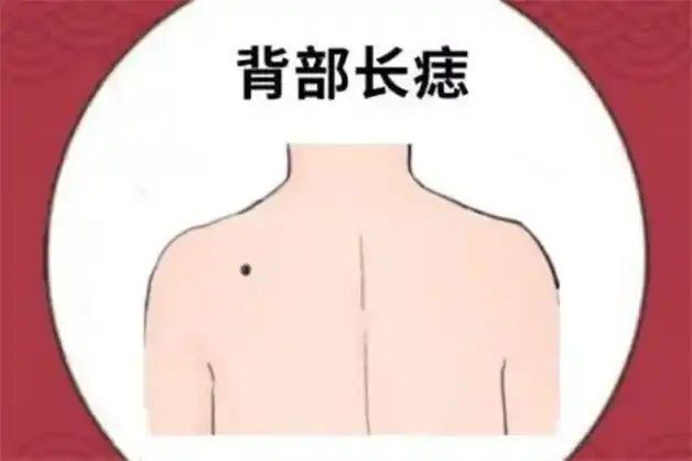后背长痣代表什么