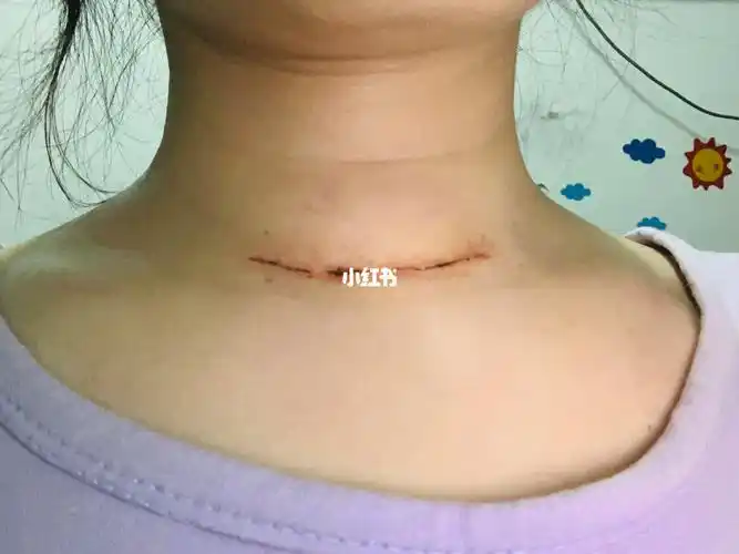 术后10天的伤口