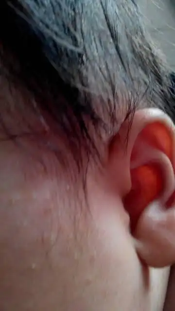 俩月宝头发额头耳鬓处长大红疙瘩,是不是是毛囊炎