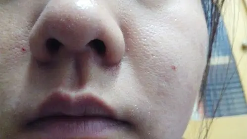 是缺水还是老化?皮肤油干油干的,洗完脸紧绷绷的,眼角笑的