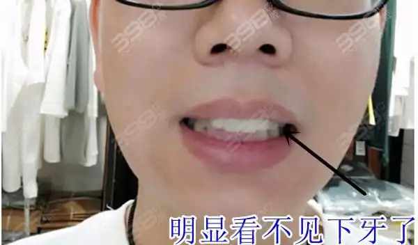 上牙盖着下牙这正常吗上牙完全覆盖下牙有什么后果