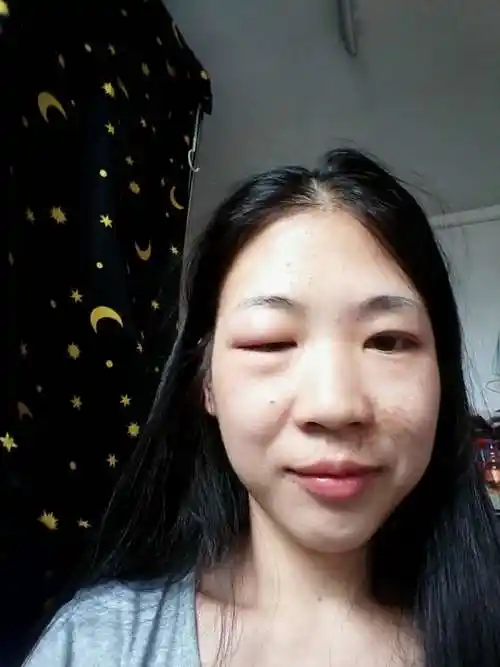 睡觉前觉得眼睛痛第二天起来发现右眼肿的好厉害