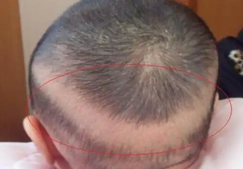 婴儿佝偻病睡姿图片