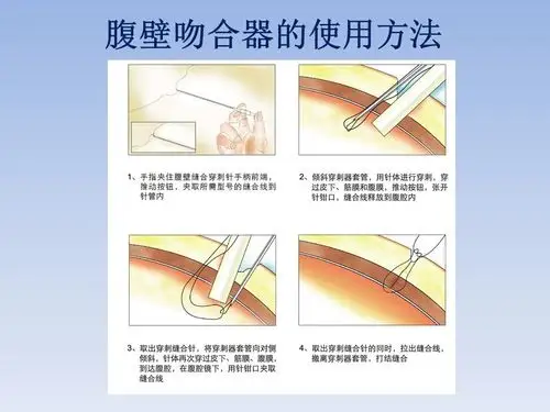 腹壁吻合器的临床应用