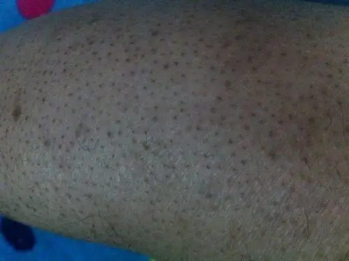 我父亲得了一种皮肤病,汗毛孔里长出许多黑色的东西