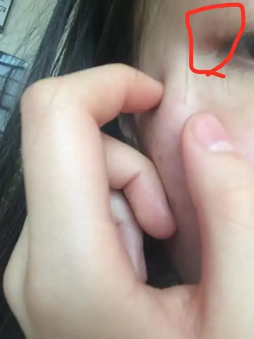 前天中午眼尾长个包 很痒 我就挠了几下 肿了 下午抹了芦荟胶 消肿了