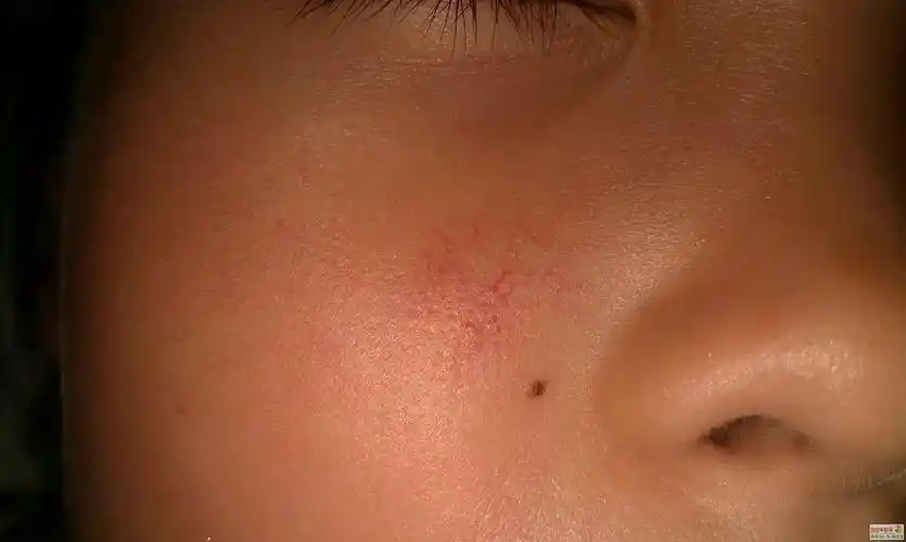请博士看看,8周岁小女孩脸上的红色血丝是怎么情况?(带图)