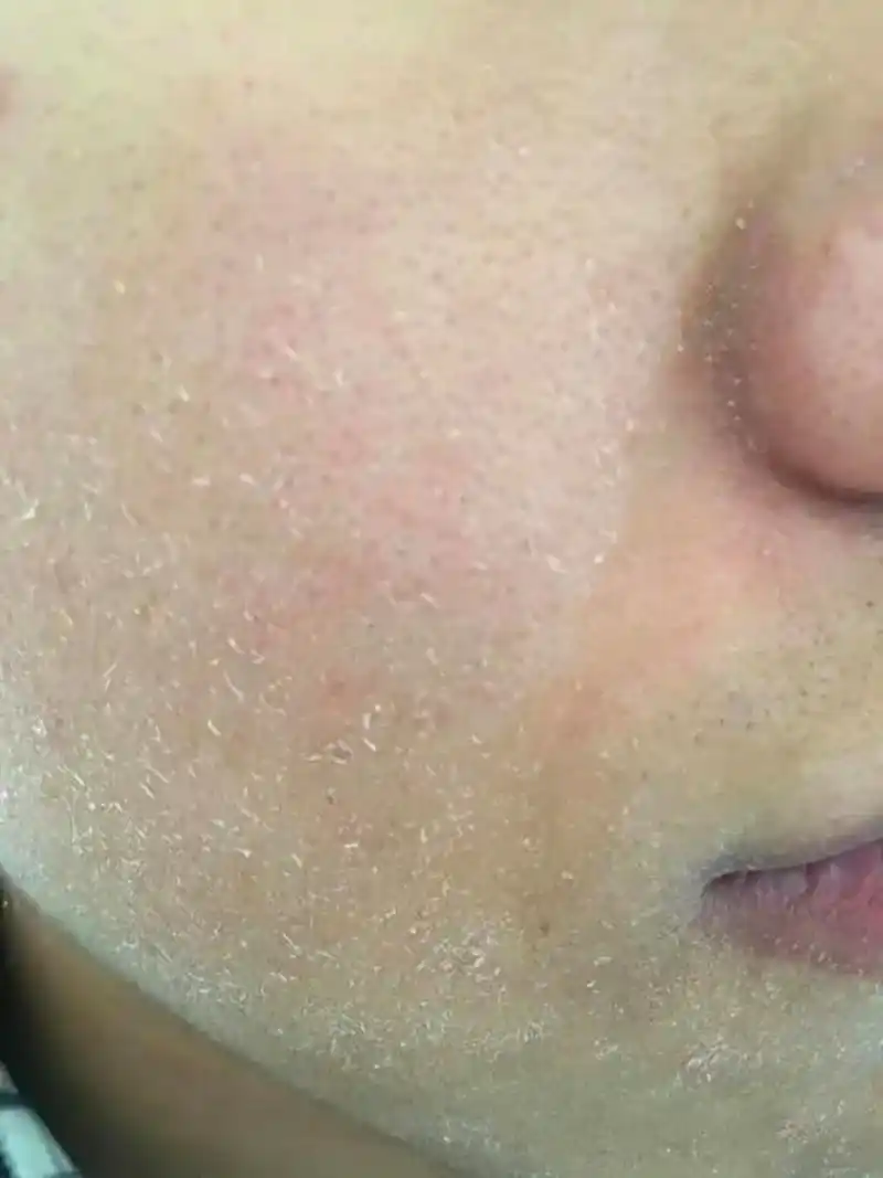 定期去角质:使用温和的去角质产品或去角质工具,可以去除皮肤表面的