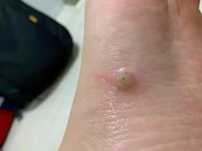兄弟们发现脚上面有可疑的肉疙瘩,或像一大颗水泡一样的一定要去医院