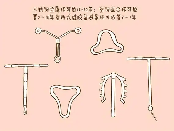 节育环是一种避孕工具