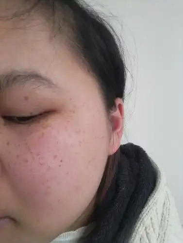 本来脸上就有遗传性雀斑,怀孕了越长越多,颜色还深,怎么办,没法出门