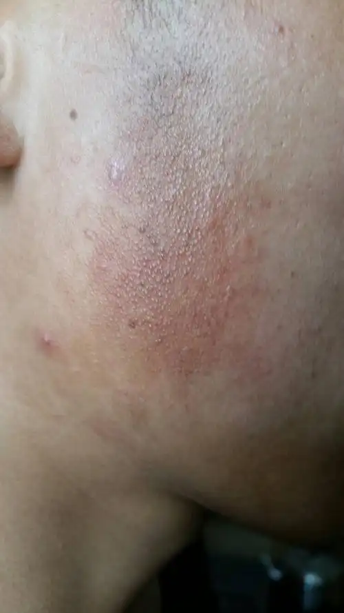 求救,这是什么皮肤病,怎么治疗?