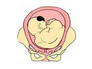 一旦发现胎位不正,就应该在医生的指导下及时纠正,让胎位转为头位.