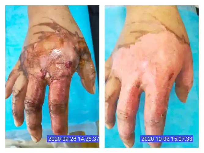 小孩烫伤起泡怎么办?别慌,一招解决(超级有_大全-幸福起航