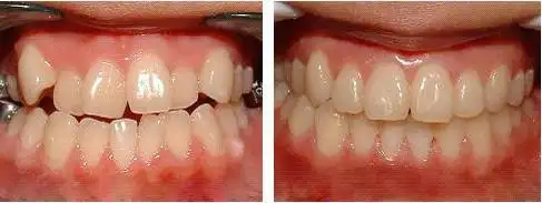 虎牙是一种常见的畸形牙齿,位于上颌唇侧错位的尖牙,它突出于牙弓之外