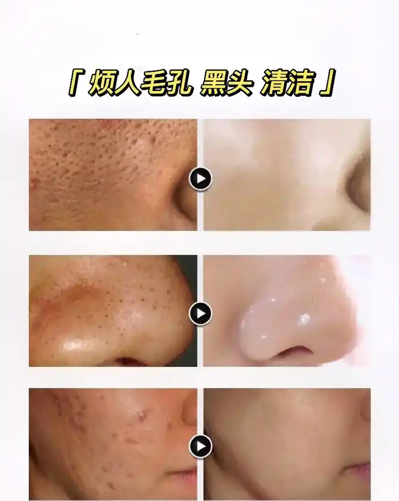 团购优惠皮肤爱出油毛孔粗大黑头多