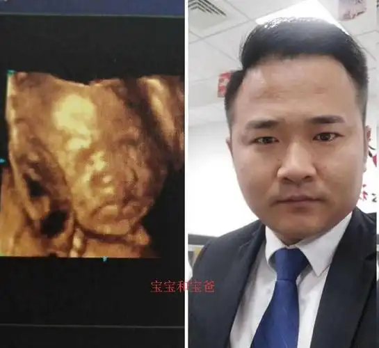 四维彩超宝宝鼻子大,知道四个原因,孕妈可以安心了