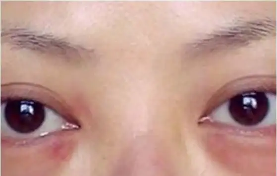 做完眼袋切除手术以后40多天了,下眼睑有点外翻有点厚看起来,还能恢复