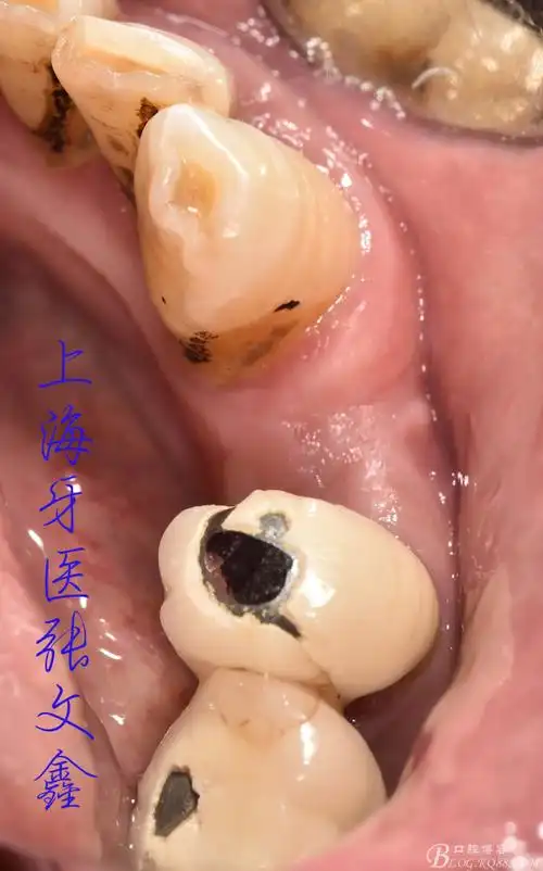 【病例展示】——下颌双尖牙缺失种植修复病例