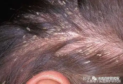 敏感头皮会起痘脂溢性皮炎还脱发怎么办