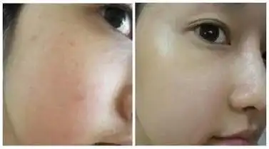 改善油性皮肤有哪些要点