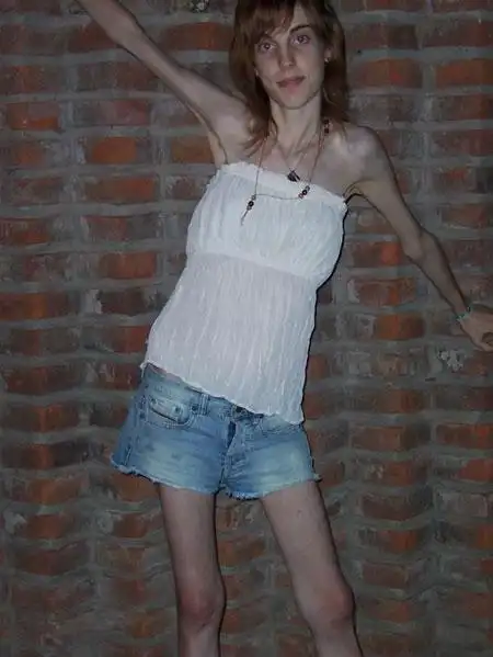 组图:瘦到只剩骨头的女人 呼吁理智减肥