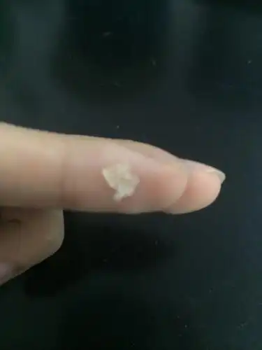 头后面头皮一块很痒都是这种头皮啊还是结痂,这是怎么了?毛囊炎吗?